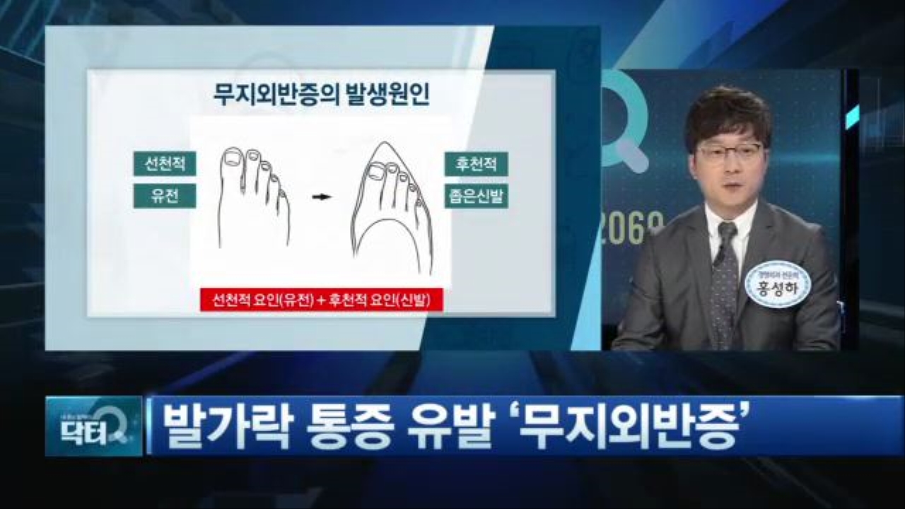 [1부] 발가락 통증 유발 '무지외반증' 썸네일