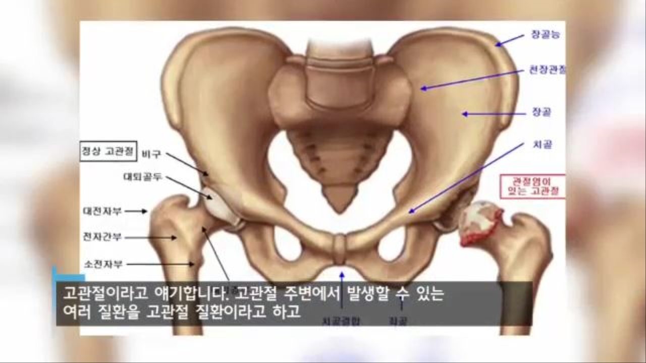 [메디포커스] 양반다리 할 때마다 '욱신'…고관절 증상과 치료법은? 썸네일
