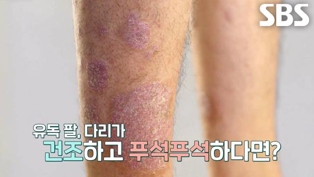 팔·다리 가려움증 느낀다면 ‘갑상샘 기능 저하증’ 의심해야 하는 이유※ (똑똑똑!고민상담소)