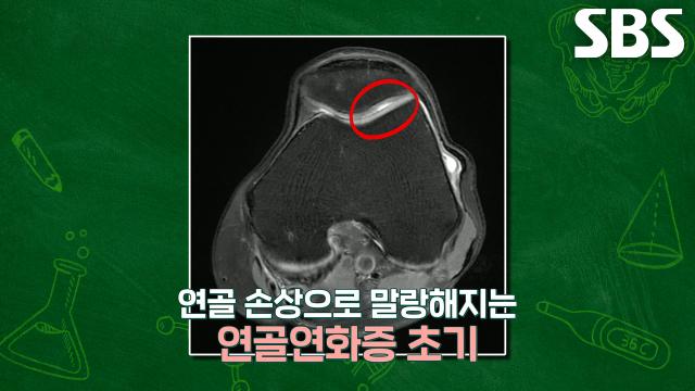 관절 약한 중장년층 여성에게 주로 발생하는 ‘연골연화증’ (더건강한스쿨)