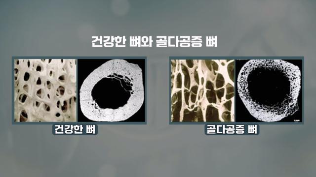 'MBP' 섭취 시 뼈 골강도 높이는 이유 썸네일