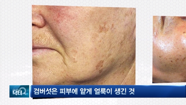 동안의 적 '검버섯'
