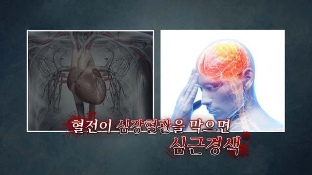 숨어있던 유령 혈관의 역습 