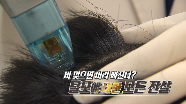533회 비 맞으면 머리 빠진다? 탈모에 대한 모든 진실 썸네일