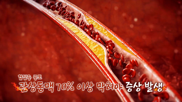 돌연사 유발 협심증 60