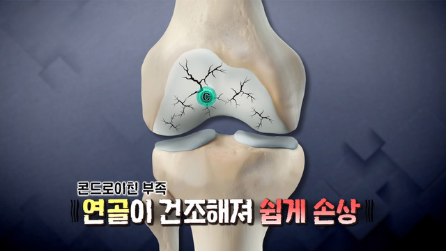 퇴행성 관절염 원인 콘드로이친 감소 65
