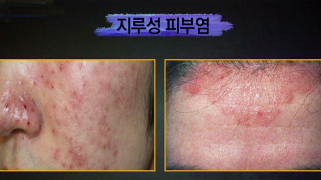 좋은아침 : 참을 수 없는 가려움 '지루성 피부염' (수요일N스타일) : Sbs