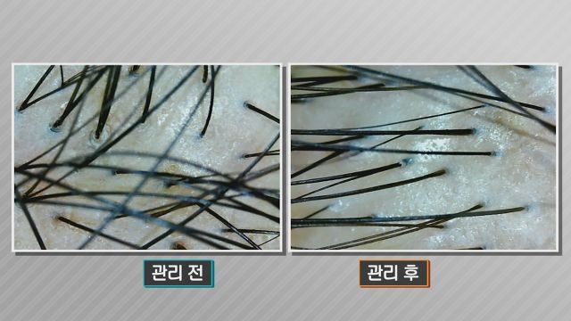 우수수~ 떨어지는 머리카락을 지켜라!