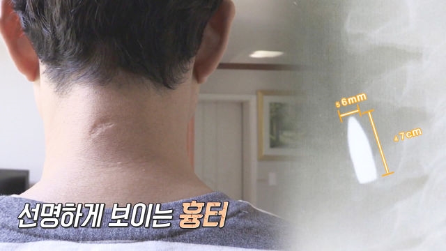 천운의 남자, 35년 만에 목에서 발견된 총알!